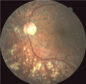 Diabetic Retina following PRP Laser